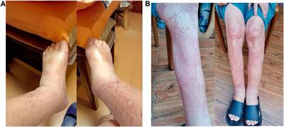 Case report: Clinical experience of treating pembrolizumab-induced systemic capillary leak syndrome (SCLS) in one patient with metastatic gastroesophageal junction squamous cell carcinoma
